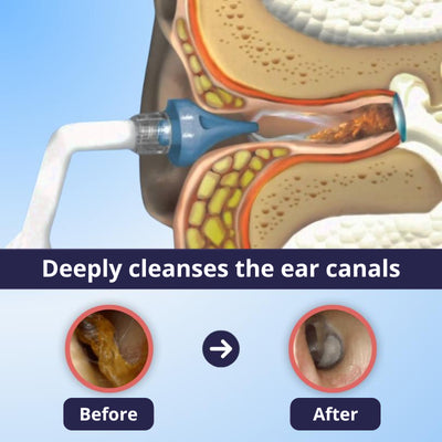 EchoRelief® relieves tinnitus symptoms