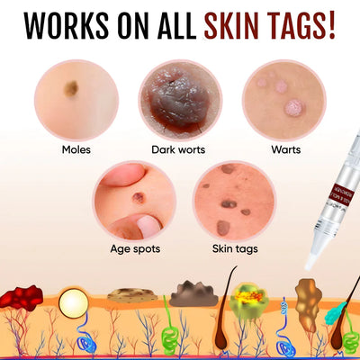 SpotClear® - Skin Tag & Mole Remover