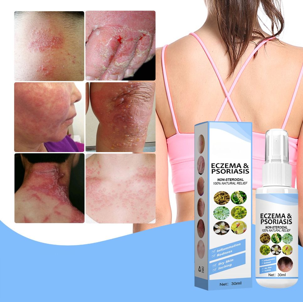 Curevita® - Eczema Relief Cream | Reduces skin diseases by 83% within 72 hours